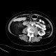 Retroperitoneal lipoma, large: CT - Computed tomography